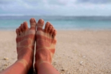 How Long Does Sunburn Last: From Redness to Recovery?